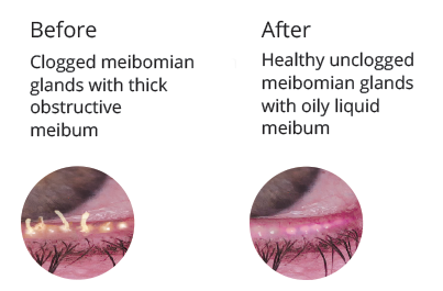 Meibomian Gland Expression